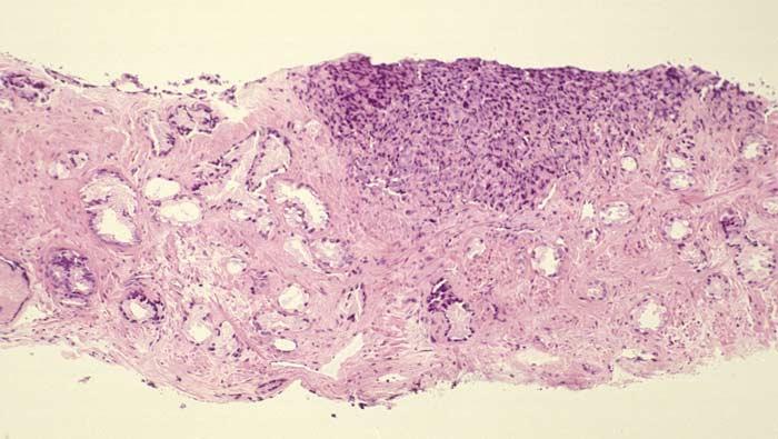 Pattern 3C is comprised of expanded cylinders or ducts with masses of cribriform or papillary tumor.