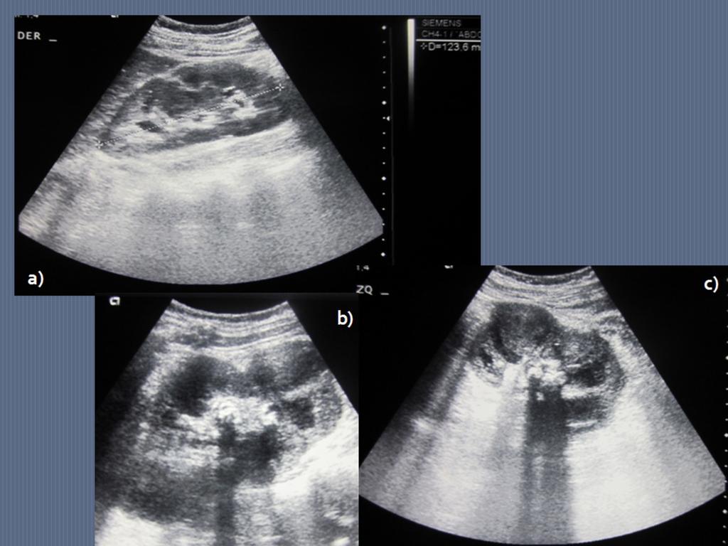 Fig. 6: 38-year-old woman with left flank pain, fever and altered renal function. Ultrasound technique of the right kidney (a) is normal.