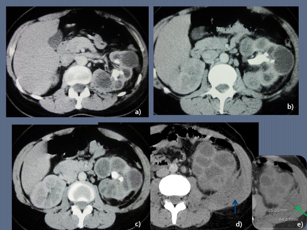 Fig. 7: Same patient as in figure 6. CT scan confirms typical features of diffuse XP in the left kidney.