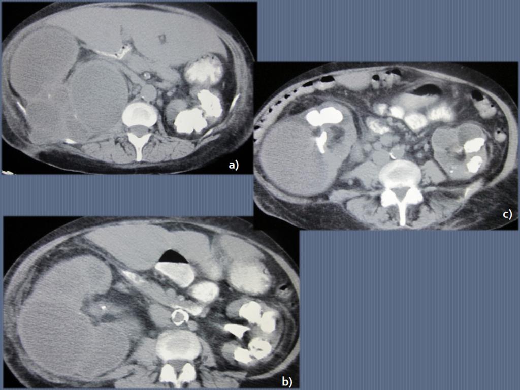 Fig. 8: 59-year-old woman with right flank pain and high-grade fever.