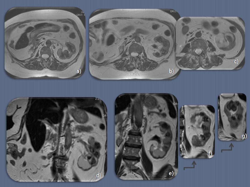 Fig. 10: Same patient as in figure 8 and 9. MRI; T2-weighted images on axial (a-c) and coronal (d-g) planes.