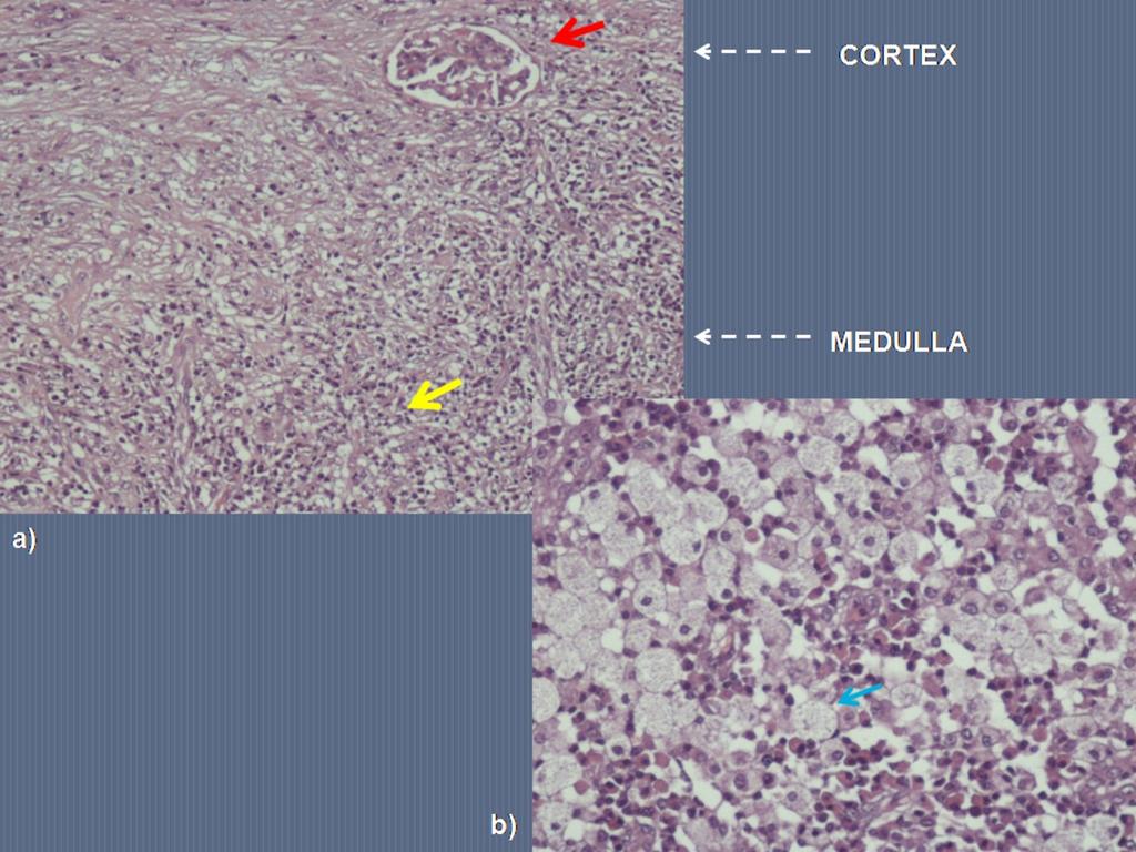 Images for this section: Fig. 1: Microscopic features of xanthogranulomatous pyelonephritis.