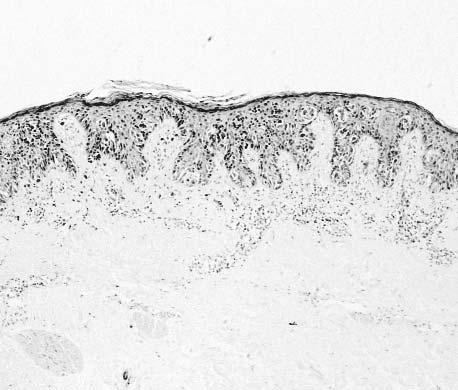 Anatomic Pathology / ORIGINAL ARTICLE A B C Image High-grade dysplasia in atypical melanocytic nevi (AMN).