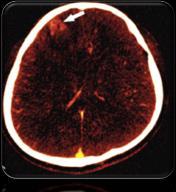 with intracerebral hemorrhage of