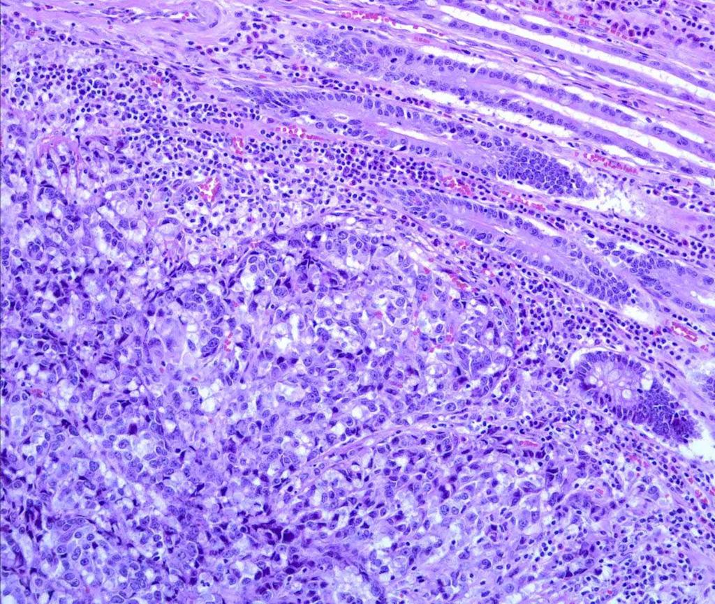 23 year old woman with melanoma of