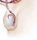 The vas deferens are lifted through the incision you may feel a tug. A small piece of the vas deferens may be removed.