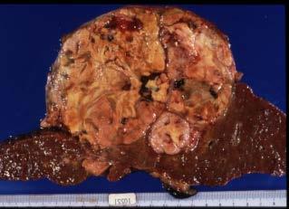 Hepatocellular carcinoma Hepatocellular carcinoma (HCC) is the histological type of liver cancer