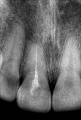 (j) Radiograph taken after completion of orthodontic treatment 11