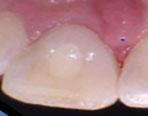 indicative of apical periodontitis due to an infected root canal