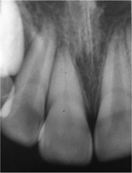 (b) Clinical photograph following surgical repositioning of 11,