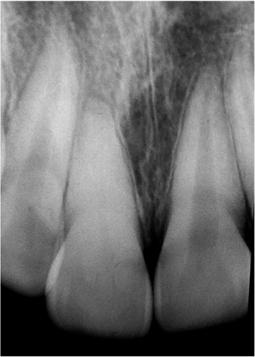 (c) Radiograph taken 18 days after surgical repositioning of the