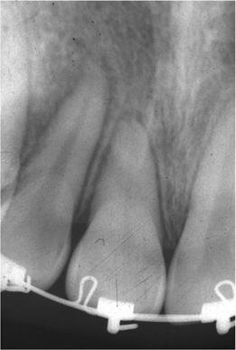(e) A 16-month follow-up radiograph shows evidence of calcification