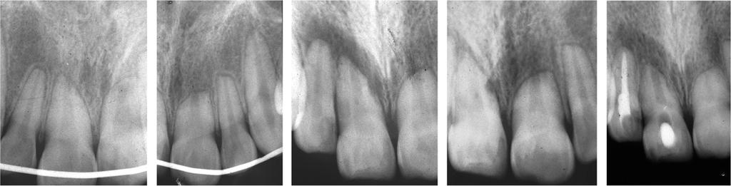 Life cycles of traumatized teeth (a) (b) (c) (d) (e) (f) (g) (h) (i) (j) Fig.
