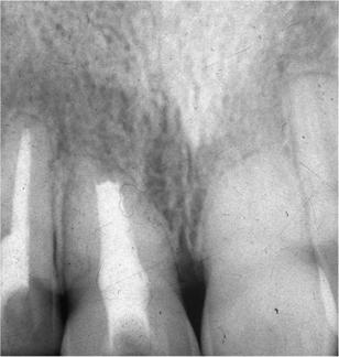 (c, d) Radiographs of the maxillary central incisors taken 6 weeks later reveal signs of infection induced external inflammatory root resorption in the right central incisor and a periapical