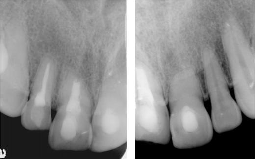 (f) Radiograph taken at the time of root filling the maxillary central incisor 12 months after the injury.