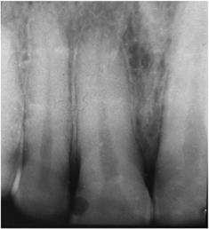 (d) A radiograph of the replanted tooth 22 years after its replantation shows some narrowing of the root canal in the apical third region of the root canal, but no evidence of periradicular pathosis.