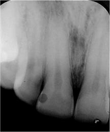 Attrition has occurred in the anterior teeth with some changes in the occlusion.