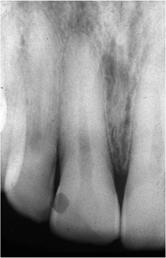 (Courtesy Dr Daniel Farmer) (k) Radiograph taken on completion of endodontic treatment. (Courtesy Dr Daniel Farmer) Bunbury, Western Australia.