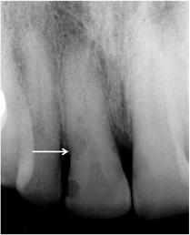 The patient was examined in 1986 when he presented for the endodontic management of a mandibular right first molar.