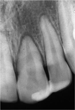 Adelaide, South Australia and avulsed both maxillary central incisors.