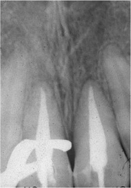 Radiographs showing the replanted teeth are shown in Fig. 4a and 4b.