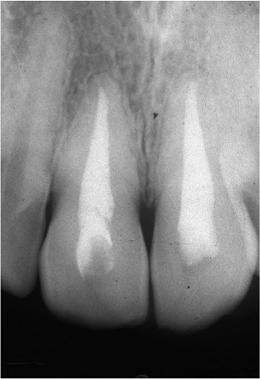 2 months (Fig. 4c and 4d) when the root canals were filled with gutta-percha and AH26 (Fig. 4e).