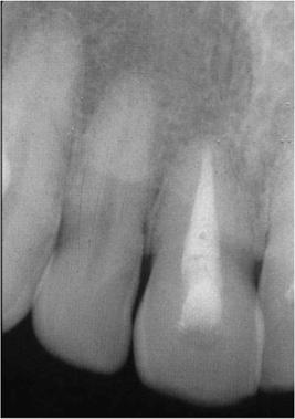 The patient has been re-examined at regular intervals since that time a photograph and radiograph taken in 1994 are shown in Fig. 4f and 4g.