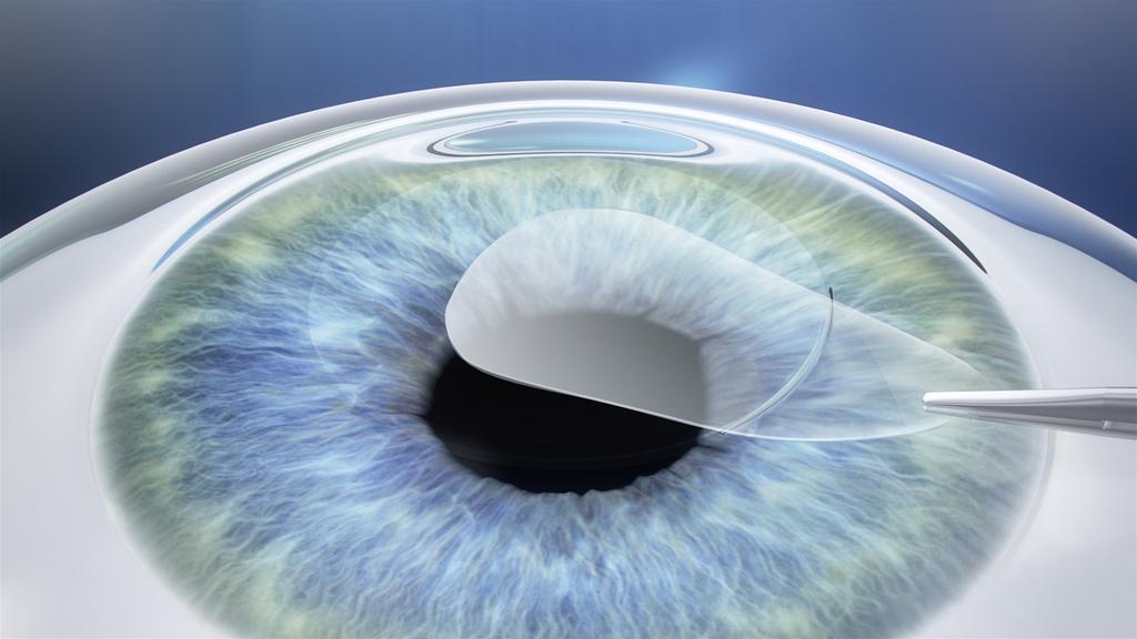 majority they are similar to fs-lasik and