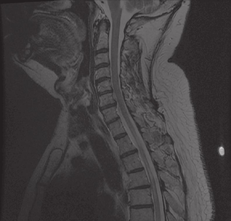 12 CASE STUDIES IN MULTIPLE SCLEROSIS Investigations An MRI of the spine (Figure 2.1) revealed a T2 hyperintense cord lesion, extending from T2 to T5, with associated gadolinium enhancement.
