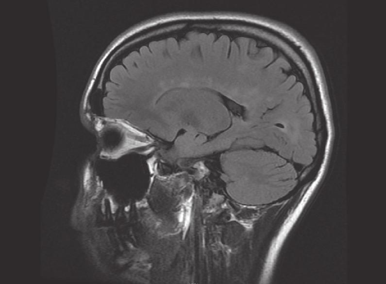CASE 2: MYELITIS 13 Figure 2.2 A sagittal FLAIR image of the brain showing multiple hyperintense white matter lesions, including Dawson s fingers.
