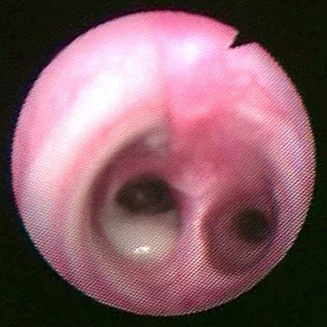 Figure 10. View of the carina in a dog with chronic bronchitis.