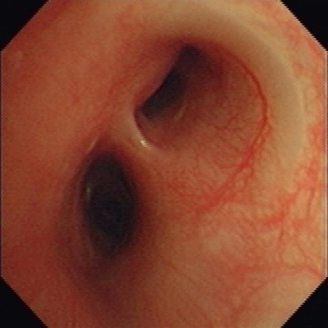 Figure 12. Left mainstem bronchus compression as result of left atrial enlargement.