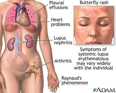 Systemic lupus erythematosus (SLE) A chronic autoimmune connective tissue disease that can affect any part of the body.