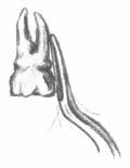 the alveolar bone. 4 cm mesial distal A 27.00 2,5 mm C 272.00 2,5 mm B 275.00 5 mm D 276.