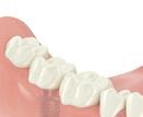 One or more dental implants can be inserted to replace the missing tooth