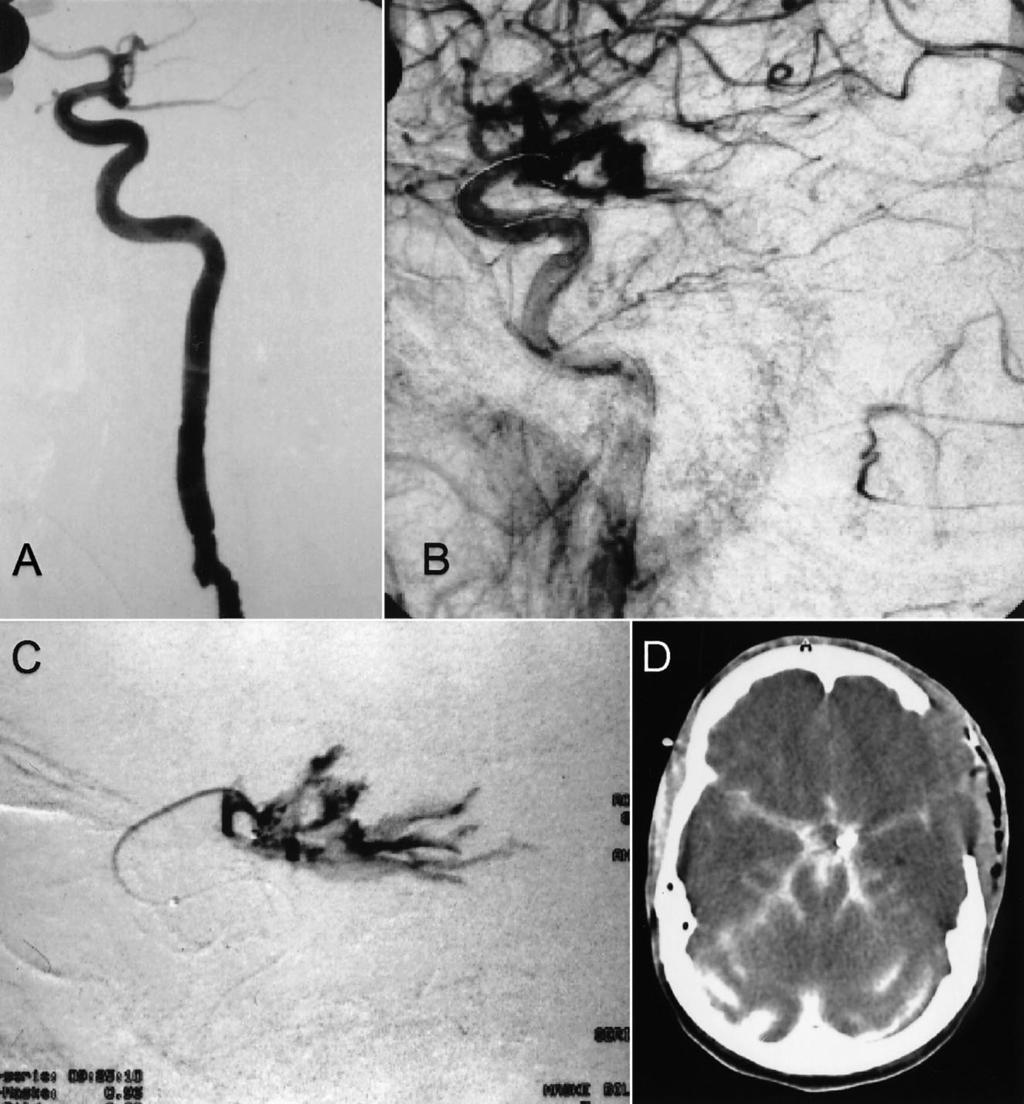 826 DOERFLER AJNR: 22, November/December 200 TABLE : Clinical data, causes, and outcomes in five patients with aneurysm rupture during embolization Patient No.