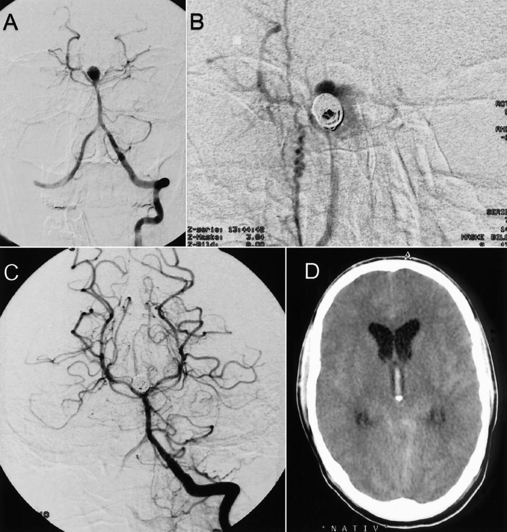 AJNR: 22, November/December 200 ANEURYSMAL RUPTURE 827 FIG 2. Case 2. A, Frontal projection arteriogram of the left vertebral artery shows a basilar tip aneurysm.