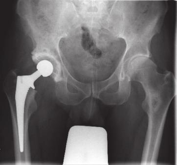 What is a Hip Replacement? A hip joint replacement operation involves removing the damaged bone, replacing the head of the femur and relining the hip socket (acetabulum), see Figure 2.