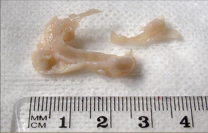 Top: tracheal necrosis and narrowing following over-inflation of an endotracheal tube.