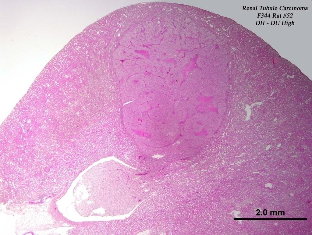 Renal Tubule Carcinoma