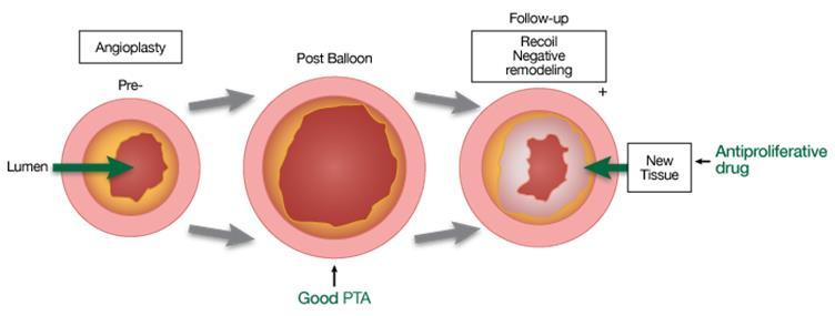 Successful DCB Treatment Mechanical (vessel recoil and negative remodeling) and biological response (smooth muscle cell proliferation) due to injury during PTA leads to stenosis Paclitaxel