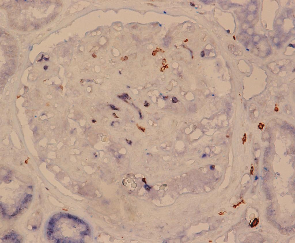 Clinical and Developmental Immunology 3 (a) (b) Figure 1: Immunohistological analysis of intraglomerular T-bet and GATA3. Positive staining is labeled in brown color.