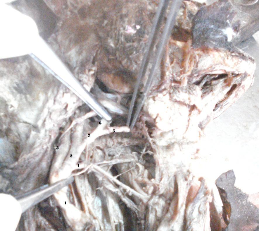 Facial Artery, 7.Hypoglosal Nerve Fig. 2: Linguofacial Trunk on right side 1.