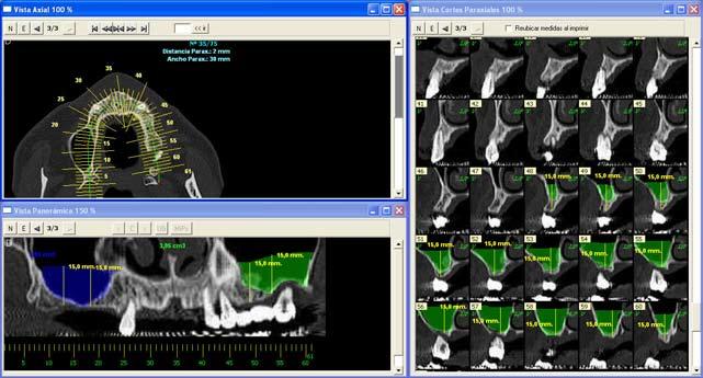 Introduction Since 99, various softwares that enable pre-implant planning and performing volume measurements have been developed, combining CT images with computer design.