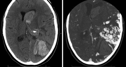 Improving yield of CT angiography in intracerebral hemorrhage TABLE 1: Baseline characteristics of patients who underwent CTA* Baseline Characteristics Negative CTA (n = 223) Positive CTA (n = 34) p