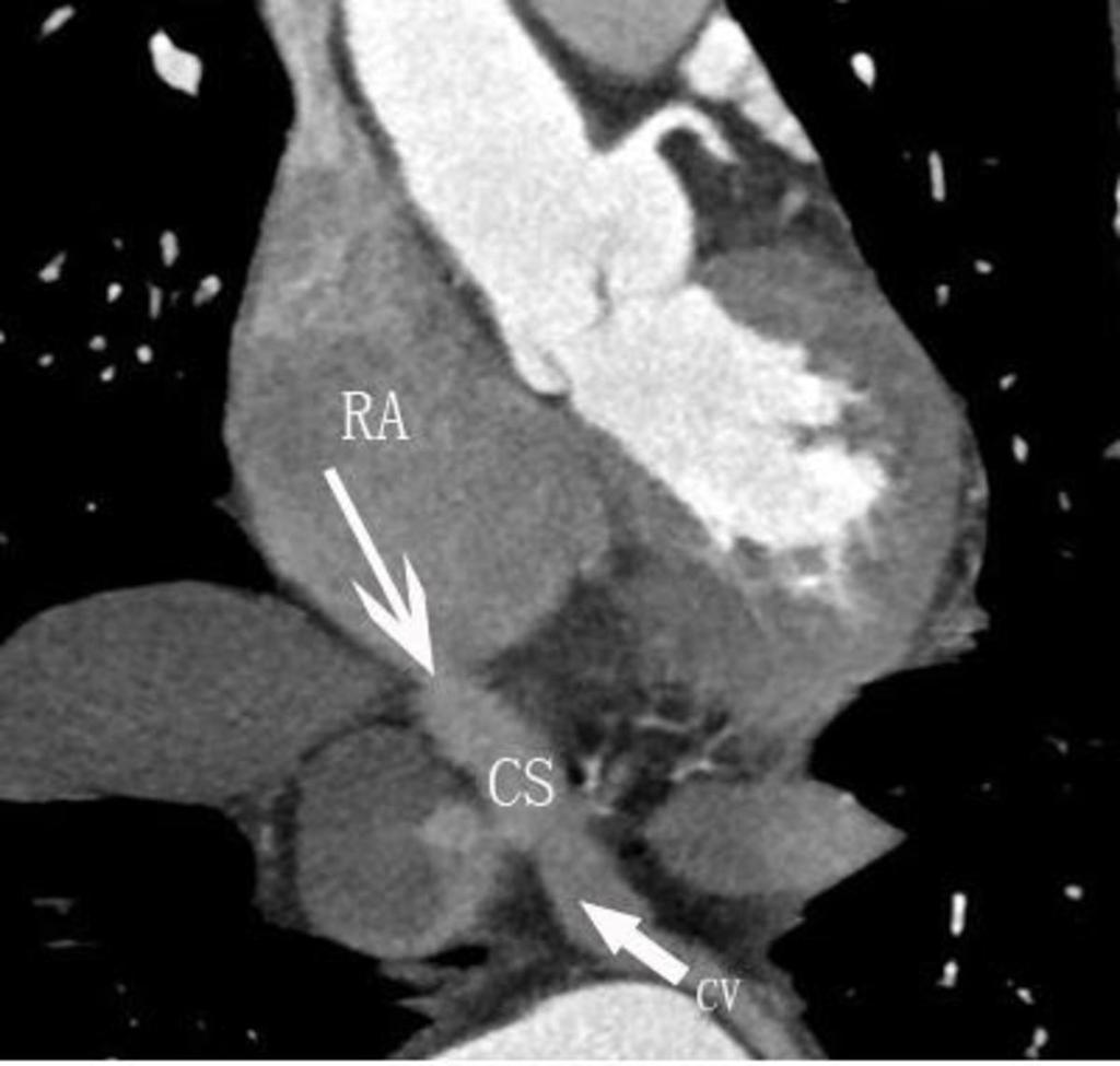 Fig. 2: Curved planar reconstruction (CPR) of the coronary sinus shows that the degree of contrast enhancement within the coronary sinus is affected by