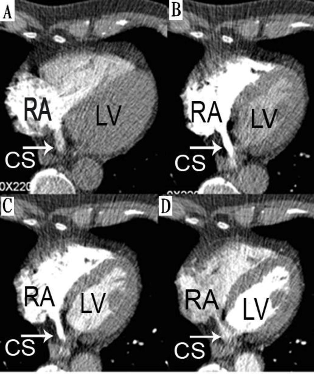 Fig. 3: Tracking the contrast material shows that the contrast moves from right atrium to right ventricle, to left atrium (not shown), to left ventricle, and