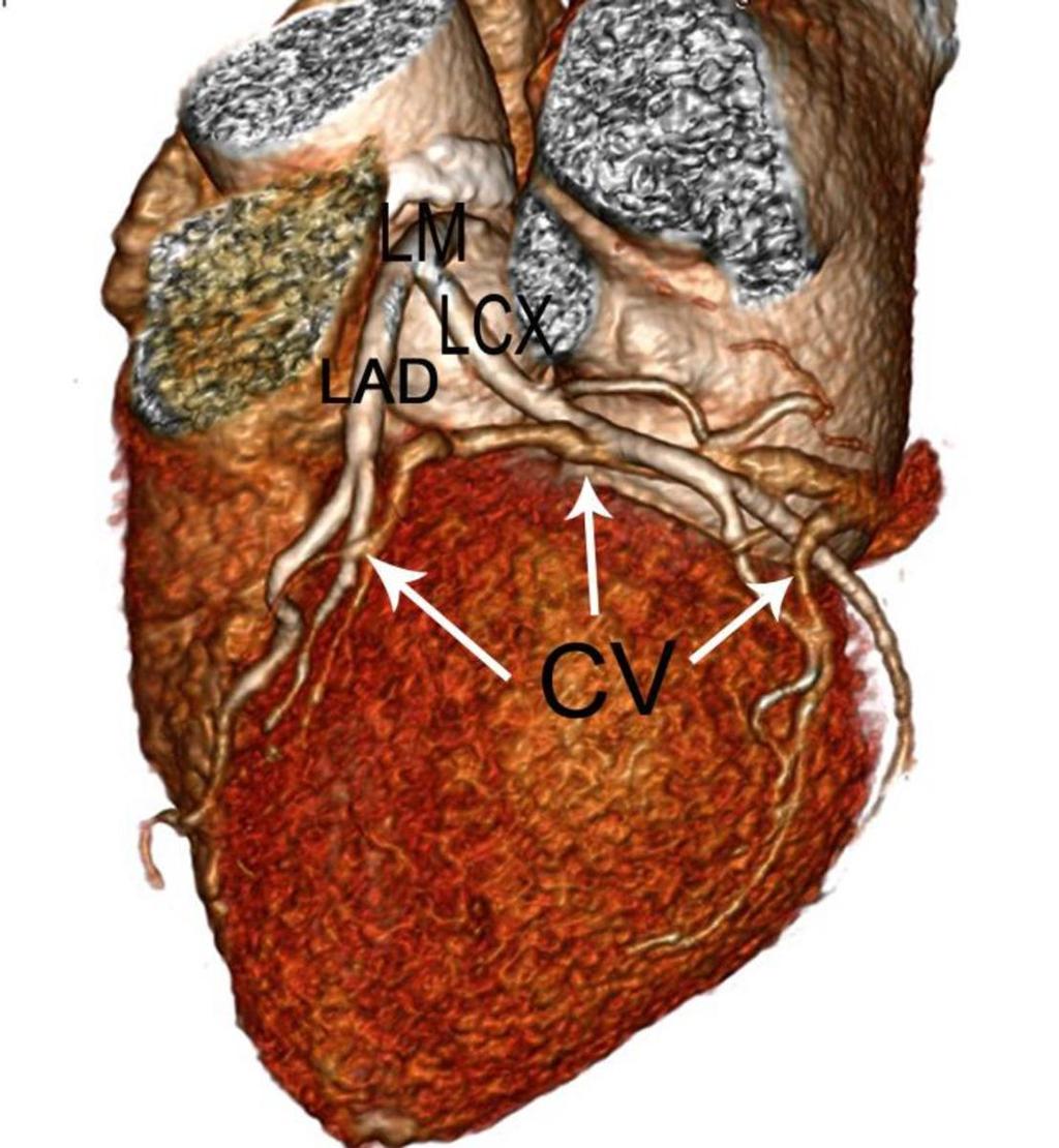 Fig. 4: Volumetric imaging shows that imaging of the coronary vein is accompanied by (or intersected by) braches of