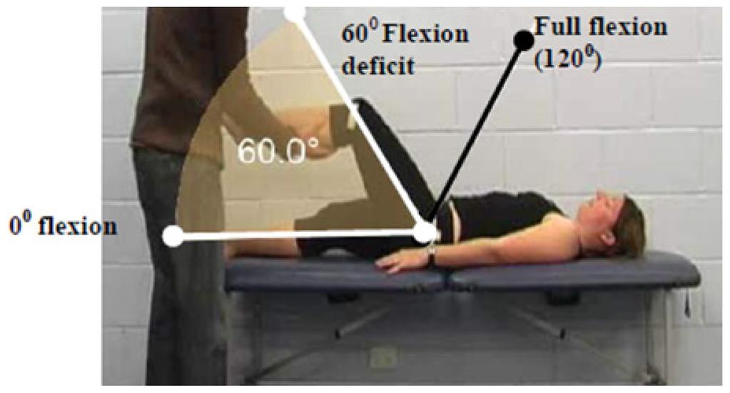 Primary Criterion #1 Hip flexion deficit of 60.