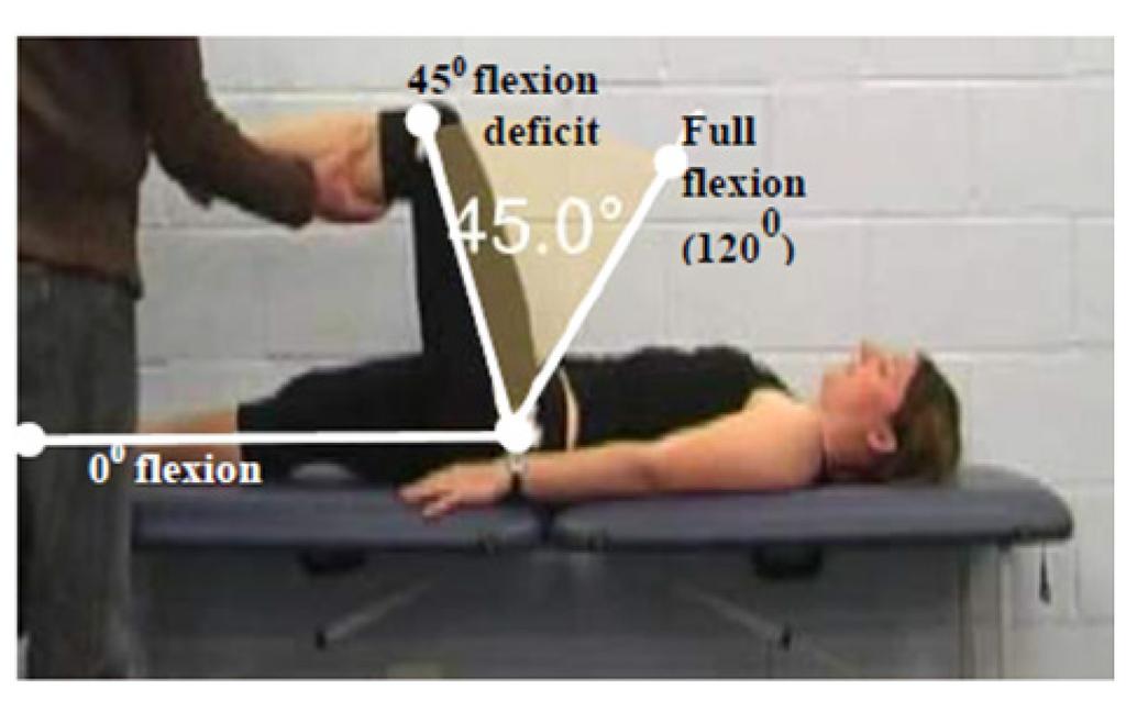 2. Secondary Criteria for impaired PROM - Lower limb Athletes are eligible if they meet TWO OR MORE of the following secondary criteria unilaterally: Secondary Criterion #1 Hip flexion deficit of 45